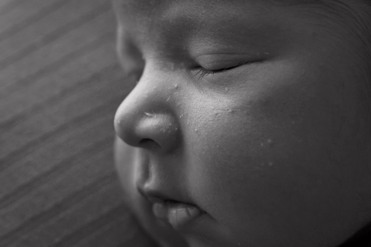 Acné du nourrisson : ces petits boutons du visage qui n&rsquo;ont rien à voir avec l&rsquo;hygiène
